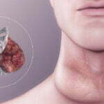 Understanding and Managing Hypothyroidism and Hyperthyroidism Hypothyroidism