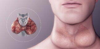 Understanding and Managing Hypothyroidism and Hyperthyroidism Hypothyroidism