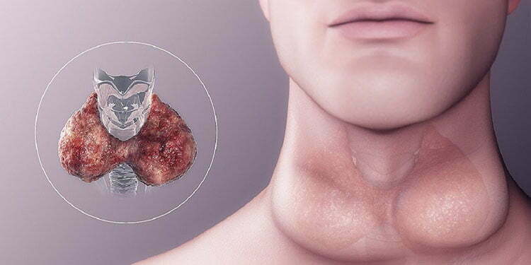 Hypothyroidism