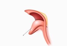When Breathing Trouble May Come From Your Larynx Medical illustration of the larynx during vocal cord dysfunction symptoms